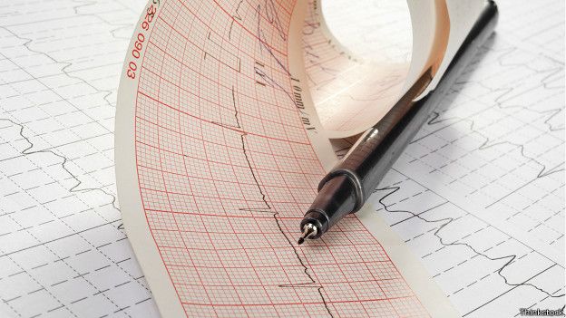 El síndrome de Bayés se puede detectar con un electrocardiograma. El síndrome de Bayés se puede detectar con un electrocardiograma.