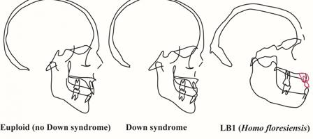 Perfiles de cráneos en personas con y sin síndrome de Down- Karen Baab