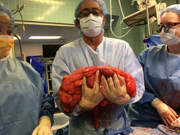 Julio Texeira posa con el tumor de más de 13 kilos