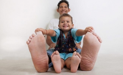 Jeison muestra las plantas de sus pies.