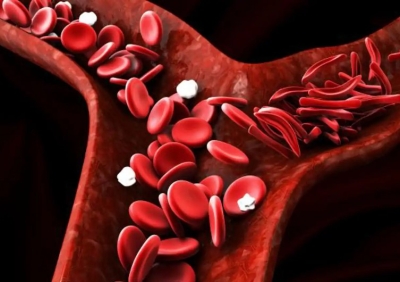 Recreación con células sanguíneas deformadas, típicas de la anemia falciforme