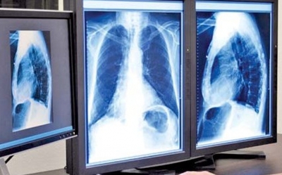 El paciente se contagió hace poco más de dos meses y sus pulmones sufrieron daño irreversible
