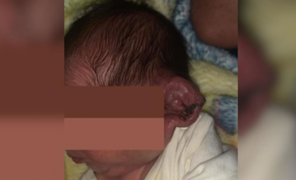 Médicos mexicanos practican una cesárea iluminados únicamente con celulares y cortan la oreja del bebé