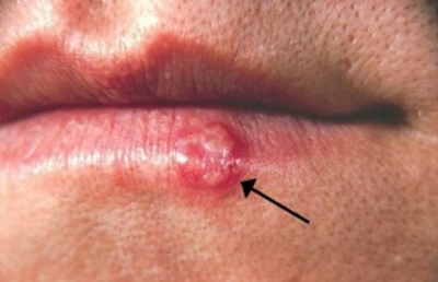 Herpes labial, causado por el virus simplex de tipo 1 (HSV-1)
