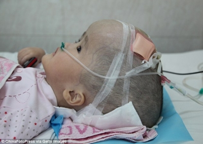 Por primera vez en la historia transplantan a una niña de tres años un cráneo hecho en impresora 3D