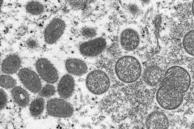 El virus de la viruela del mono podría consolidarse como una nueva ETS en los EE. UU.