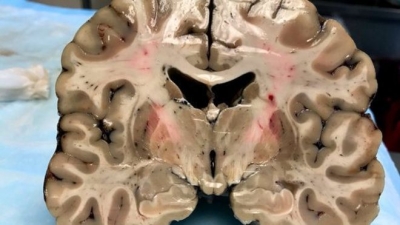 A pesar de su apariencia saludable exterior, el cerebro de Hernández estaba profundamente dañado por la encefalopatía traumática crónica.