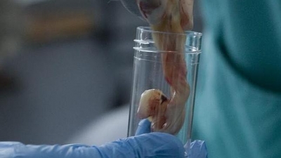 Un consorcio internacional intentará curar el VIH con células madre del cordón umbilical