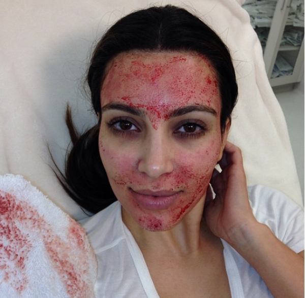 EE.UU.: Diagnostican con VIH a dos clientes de un spa de Nuevo México que ofrecía el &#039;vampiro facial&#039;