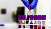 Inician en Rusia los primeros ensayos clínicos de una vacuna contra el cáncer