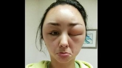 Todo se debió a una terrible reacción alérgica