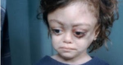 Malformaciones en bebés: La herencia envenenada de las municiones de uranio empobrecido estadounidenses en Iraq