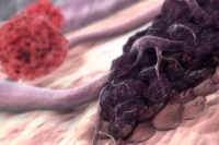 El caso del hombre que murió de un cáncer "no humano"