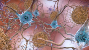 Placas beta-amiloides y tau en el cerebro