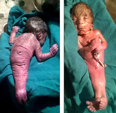 Nace en la India un niño con el 'síndrome de la sirena'