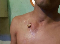 Un juez argentino denuncia que un preso lleva 2 meses con una fractura expuesta