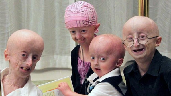 Pacientes con progeria 