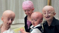 Pacientes con progeria