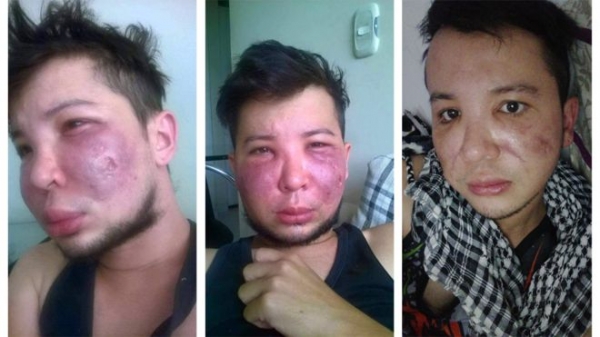 Hoy (foto de la derecha), Jerson Trujillo dice que ha recuperado el 50 o el 60% de su rostro, tras cuatro cirugías de reparación. Pero estima que aún le quedan dos más.